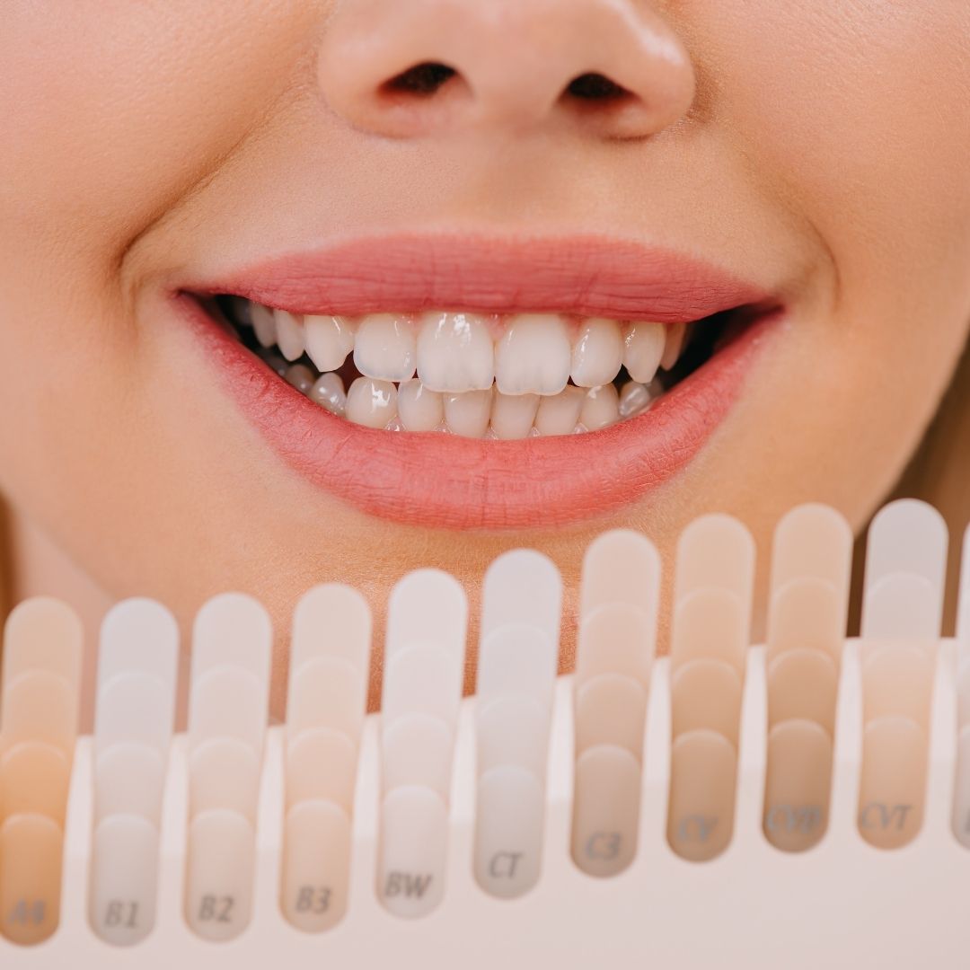 Blanqueamiento de dientes: ¿Qué es y cómo funciona?